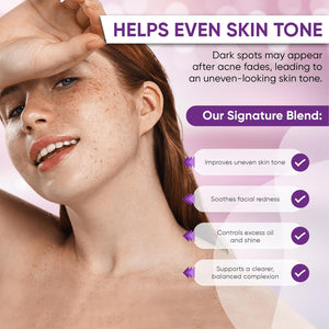 AOBBIY Azelaic Acid Acne Cream