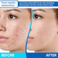 AOBBIY 12% Azelaic Acid Acne Cream, 1 Oz